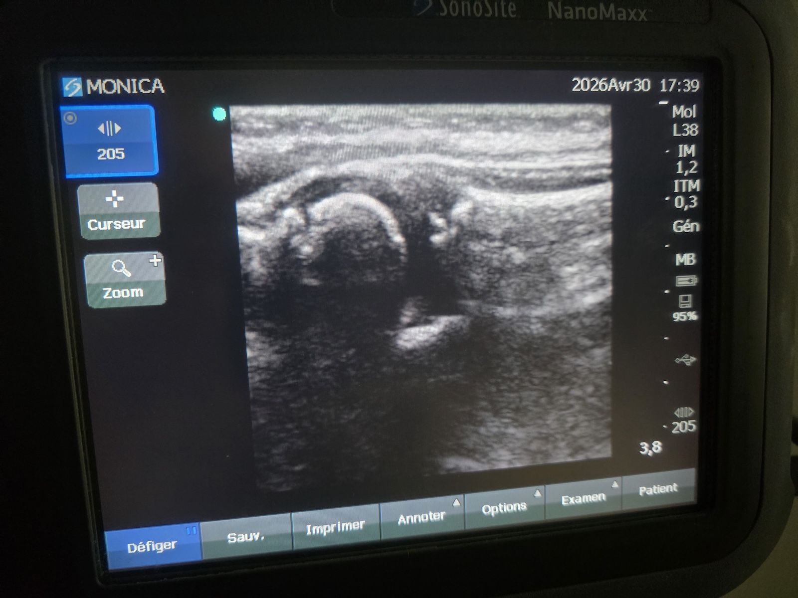 Image(s) de l'annonce Échographe SonoSite NanoMaxx + sonde L38 + Doppler couleur – idéal kiné / sport / MSK