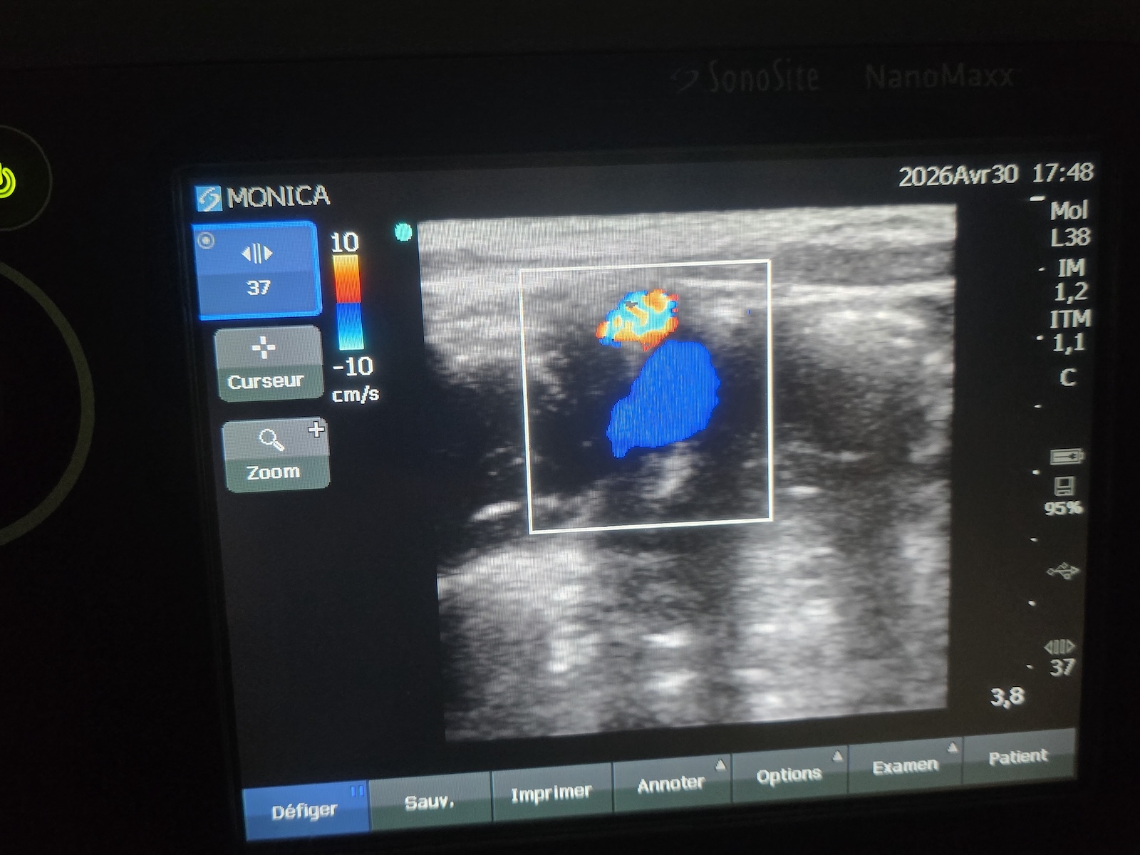 Image(s) de l'annonce Échographe SonoSite NanoMaxx + sonde L38 + Doppler couleur – idéal kiné / sport / MSK