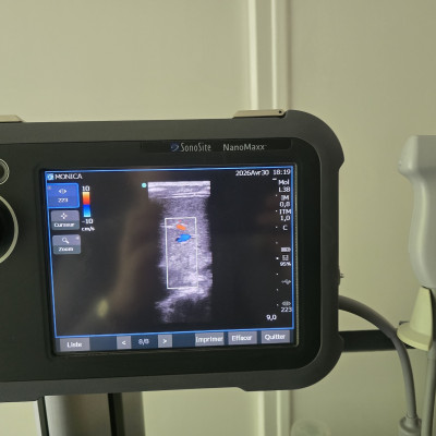 Image(s) de l'annonce Échographe SonoSite NanoMaxx + sonde L38 + Doppler couleur – idéal kiné / sport / MSK
