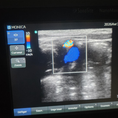 Image(s) de l'annonce Échographe SonoSite NanoMaxx + sonde L38 + Doppler couleur – idéal kiné / sport / MSK